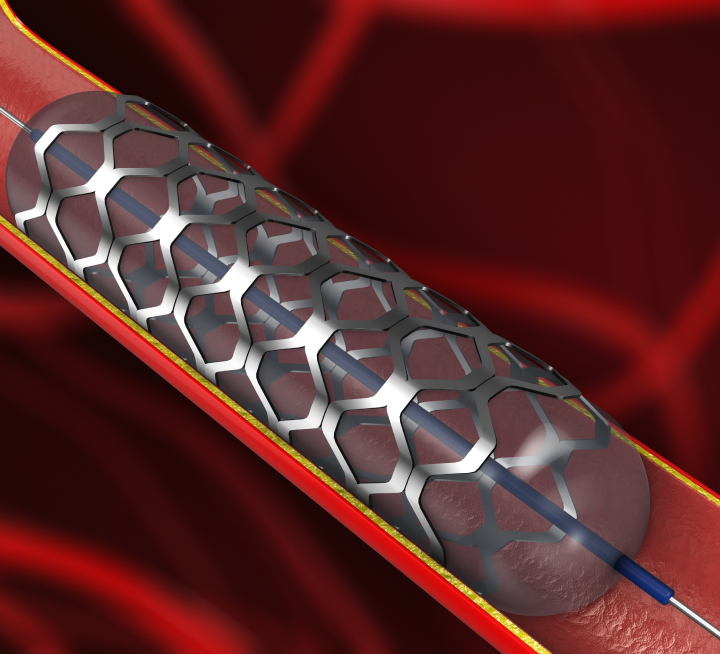 Image agiogram angioplasty d