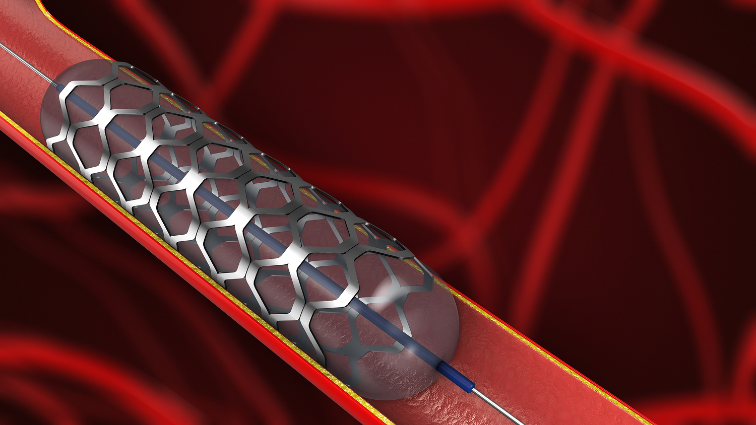 Image angiogram angioplasty